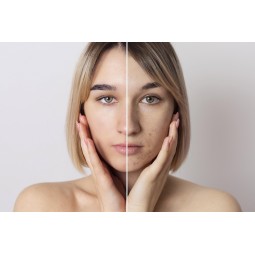 Pelle-senza-imperfezioni-acne-brufoli